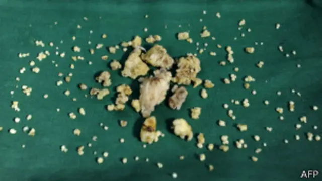 Удаленные зубы