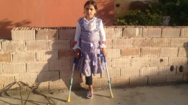 مريم فقدت ساقها في قصف جوي سوري استهدف منزلها