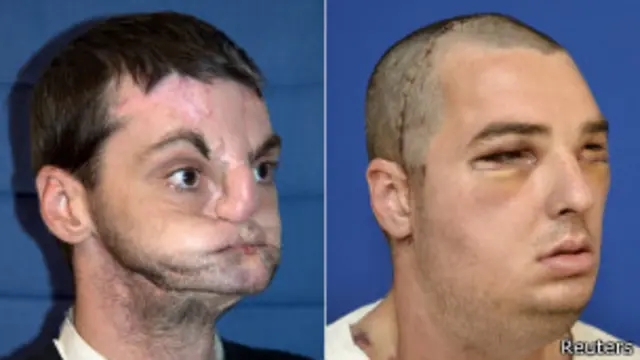 El antes y el después de la intervención.