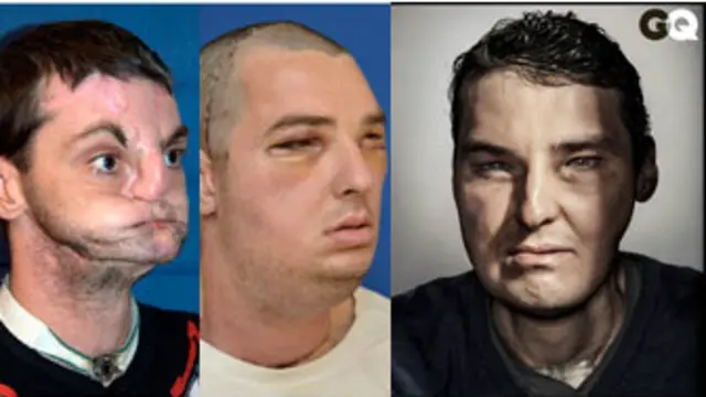 مسٹر نورس اپنے ہونٹ اور ناک گنوا بیٹھے تھے اور وہ اپنا منہ بھی زیادہ ہلا نہیں پاتے تھے