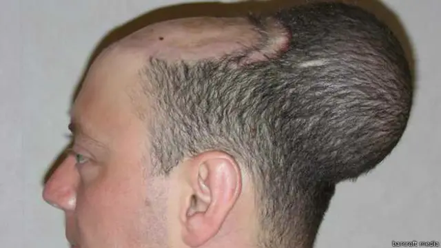 Pria ini mengaku tidak nyaman dengan "benjolan balon" di atas kepalanya, utamanya saat tidur malam.