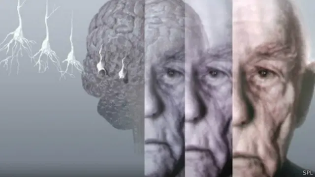 老年痴呆症的症状包括，记忆力减退、思考和解决问题的能力或语言能力出现困难。