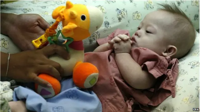 Bé gái sinh đôi cùng với Gammy đã được bố mẹ ruột đưa về Australia