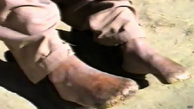 ठंड से गल जाने के कारण मेहदी के पैरों की उंगलियों को काटना पड़ा