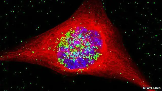 纳米金核球体破坏癌细胞