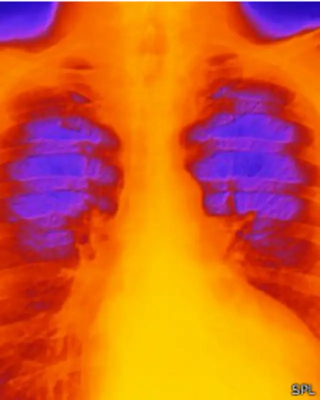 أشعة سينية ملونة لمريض يعاني من اعتلال عضلة القلب