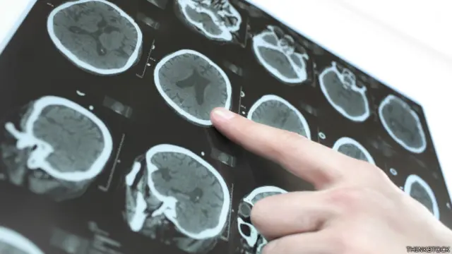 Enfermedad de Parkinson.