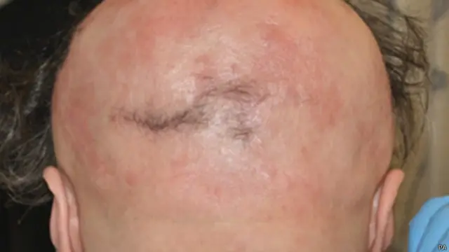 Очаговая алопеция