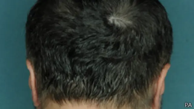 Очаговая алопеция