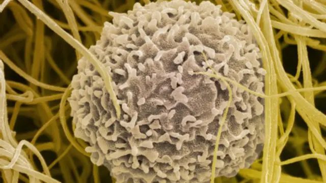 மருத்துவர்கள் உருவாக்கிய கழுத்துக்கணையம்