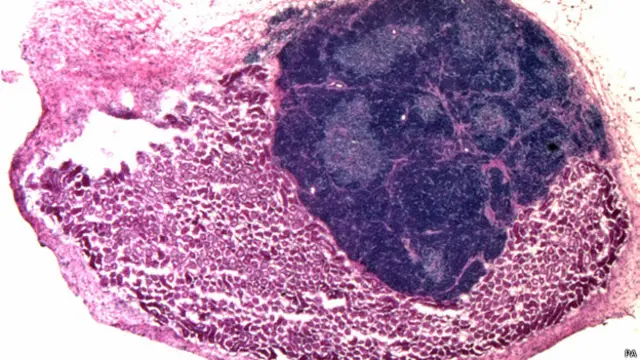 கழுத்துக்கணையம் உருவாகும் ஆரம்ப நிலை