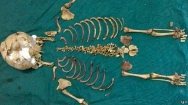 වසර තිස් හයකට පසු ඉවත් කළ කලල ඇට සැකිල්ල 