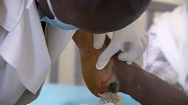 Talón infectado tratado con larvas