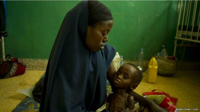 Niño desnutrido y deshidratado en el Hospital Benadir de Mogadiscio (Crédito: André Liohn/CICR)