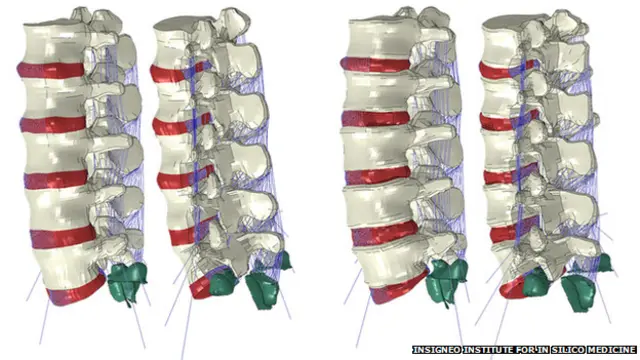 Mediante el uso de modelos del cuerpo, los cirujanos pueden probar tratamientos potenciales y ver qué tan efectivos son.