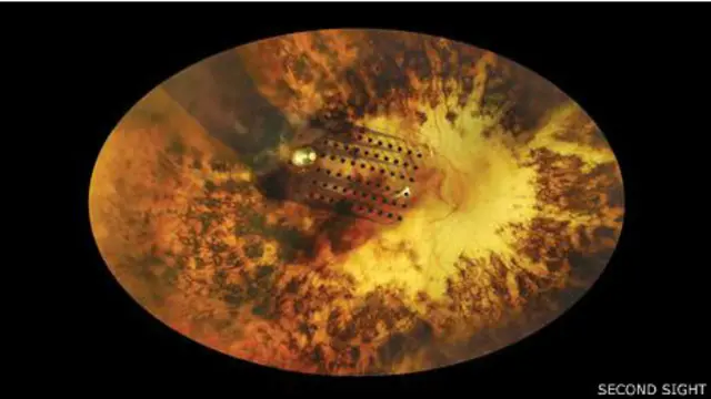 Eletrodos na retina. Foto: Second Sight