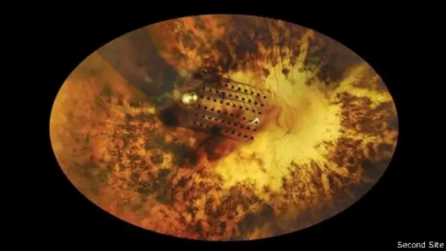 الأقطاب الكهربائية التي تزرع في الشبكية يمكنها تجاوز الجزء التالف داخل العين