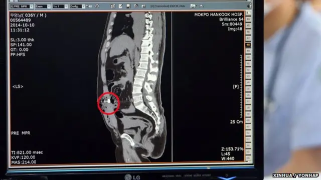 木浦韩国医院发放船长船长宋厚朴的CT扫描图(新华社/韩联社图片10/10/2014)