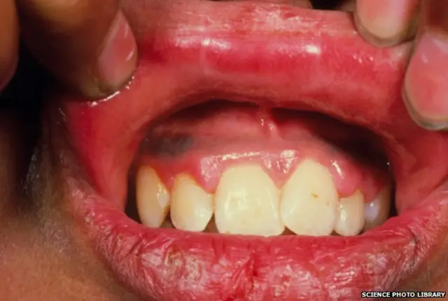 Enfermedad de las encías