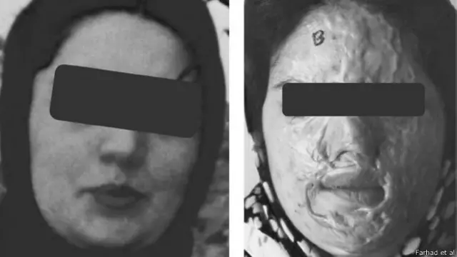 برای بازگرداندن قربانی به جامعه به جراحیهای بازسازی و ترمیم و حمایت های ذرمانی و پزشکی زیادی نیاز است