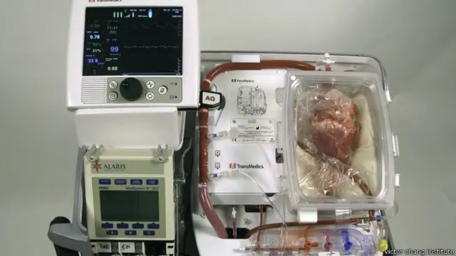 Konsol tempat jantung "diaktifkan lagi" dalam apa yang disebut mesin "jantung dalam kotak".
