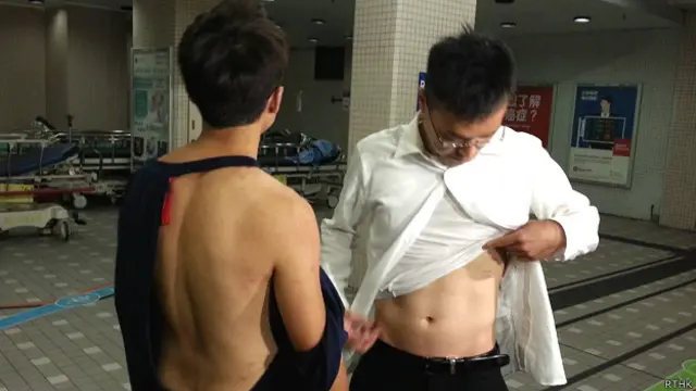 无线电视记者冼志（右）与新闻摄影师雷钊河（左）在医院向记者们展示伤势（香港电台图片25/10/2014）