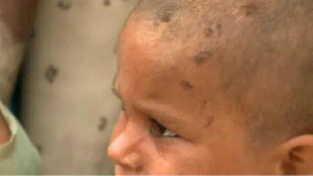 سیلاب متاثرین کا کہنا ہے کہ گندے پانی کی وجہ سے انھیں جلد اور پیٹ کے امراض لاحق ہو رہے ہیں