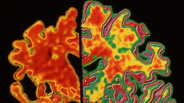 Maradhi ya Alzheimer