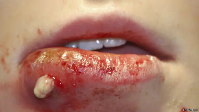 عفونت پوستی ناشی از MRSA