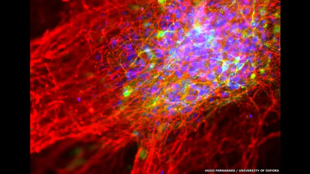 Штучно створені нервові клітини мають величезний потенціал для лікування хвороби Паркінсона, каже пан Фернандес. 