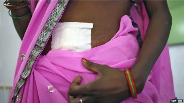 印度最近有15名妇女做绝育手术而死亡。