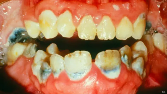 Испорченные зубы