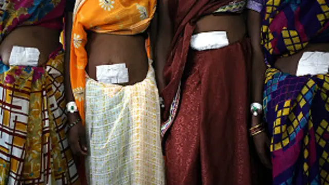 महिलाओं की नसबंदी