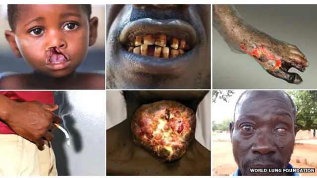 Imágenes gráficas contra el tabaco en África