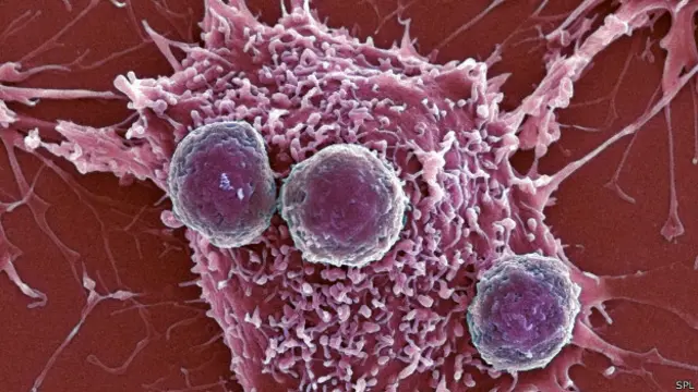 Una de las técnicas de inmunoterapia contempla el cultivo de linfocitos para que reconozcan al tumor y lo eliminen.