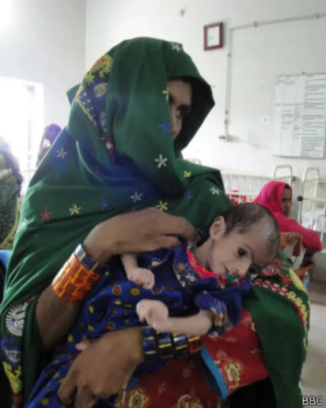 تھر کے دس ہزار بچوں میں غذائی قلت کی علامات پائی گئیں