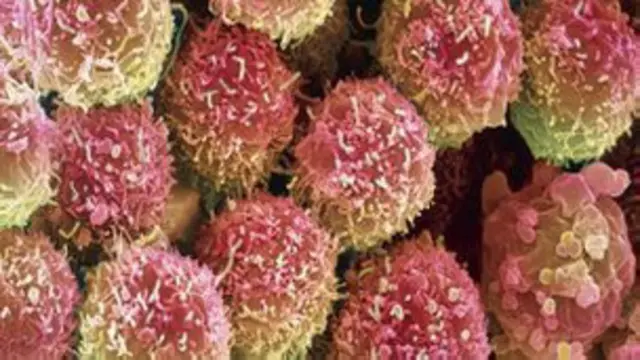 La inmunoterapia ha mostrado su eficacia tanto en el melanoma metastásico como con algunos tumores de pulmón y riñón.