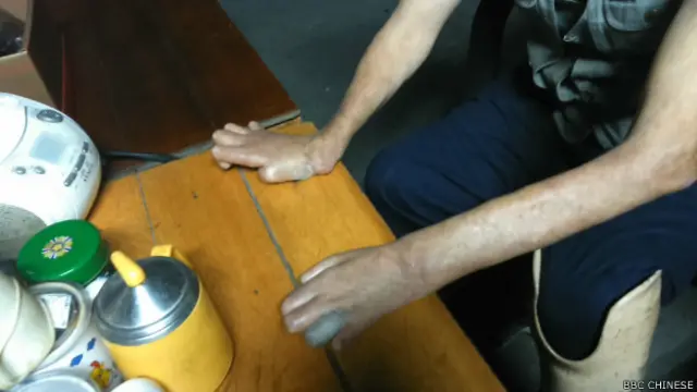 黃文章的手，因為漢生氏症的關係而變形。