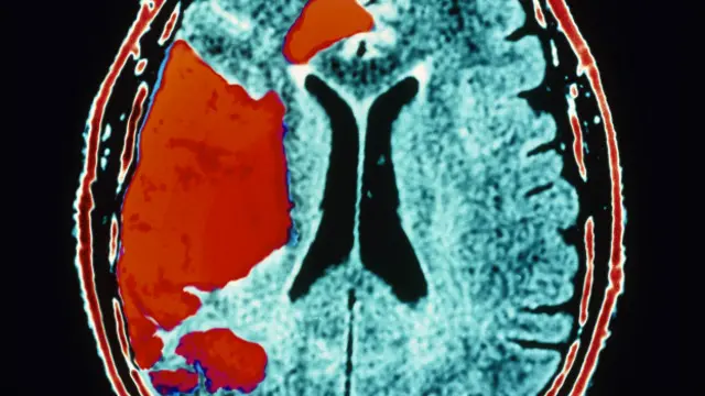 Accidente cerebrovascular