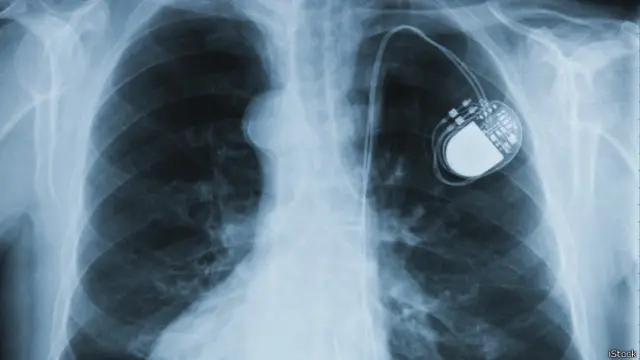 Кардиостимулятор