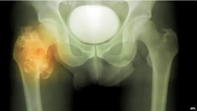 बोन कैंसर