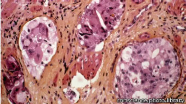 पेट के कैंसर के विषाणु