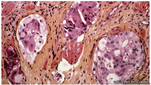 Banyak gejala kanker perut disangka karena penyakit lain