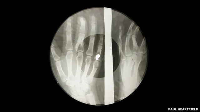 Пластинка, записанная на рентгеновском снимке