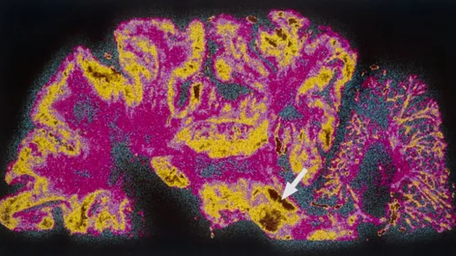 أثبت فحص بالأشعة حدوث تدهور في المخ لدى مرضى الشلل الرعاش