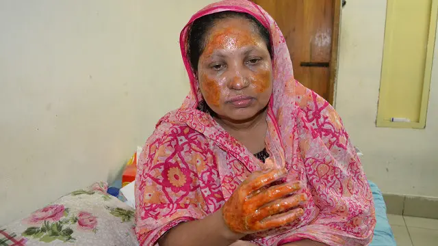 পেট্রোল বোমা হামলার শিকার