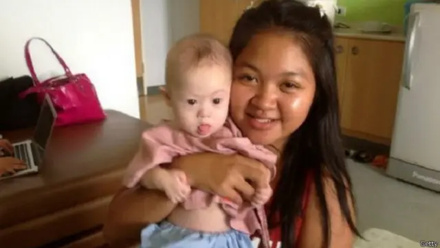 Kasus bayi Gammy menjadi berita di seluruh dunia