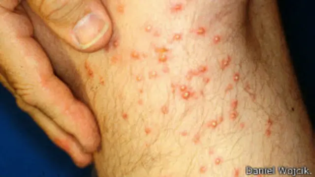 Picadura de hormigas coloradas