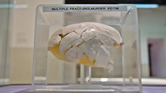Восстановленный по фрагментам череп жертвы преступления 