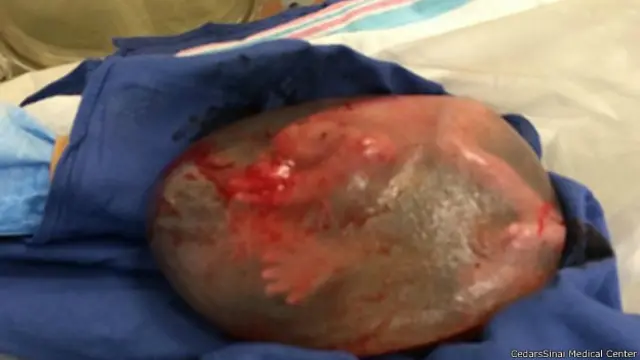 O surpreendente caso do bebe que nasceu em bolsa amniotica intacta BBC News Brasil